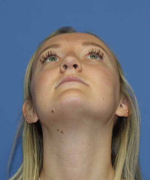 Rhinoplasty 5291 – Click HERE for more views before photo. Individual results may vary.