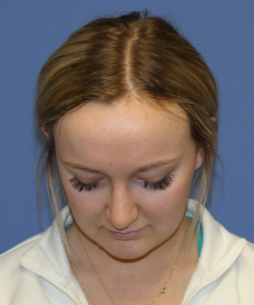 Rhinoplasty 5291 – Click HERE for more views after photo. Individual results may vary.