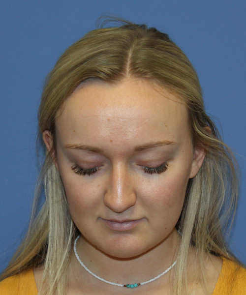 Rhinoplasty 5291 – Click HERE for more views before photo. Individual results may vary.