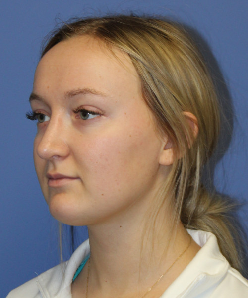 Rhinoplasty 5291 – Click HERE for more views after photo. Individual results may vary.