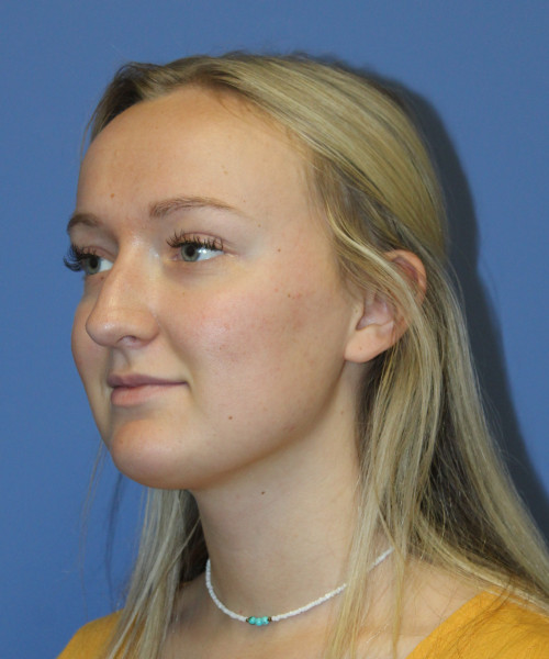 Rhinoplasty 5291 – Click HERE for more views before photo. Individual results may vary.
