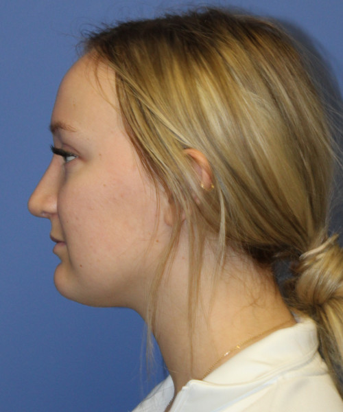 Rhinoplasty 5291 – Click HERE for more views after photo. Individual results may vary.
