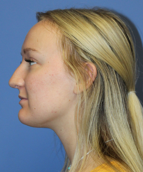 Rhinoplasty 5291 – Click HERE for more views before photo. Individual results may vary.