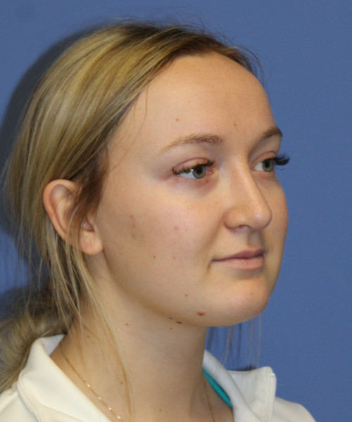 Rhinoplasty 5291 – Click HERE for more views after photo. Individual results may vary.