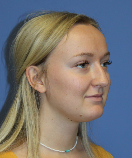 Rhinoplasty 5291 – Click HERE for more views before photo. Individual results may vary.