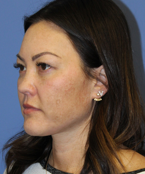 Blepharoplasty (eyelids) 5306 – Click HERE for more views after photo. Individual results may vary.