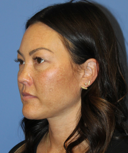 Blepharoplasty (eyelids) 5306 – Click HERE for more views before photo. Individual results may vary.