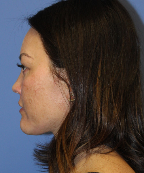 Blepharoplasty (eyelids) 5306 – Click HERE for more views after photo. Individual results may vary.