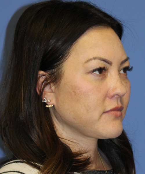 Blepharoplasty (eyelids) 5306 – Click HERE for more views after photo. Individual results may vary.
