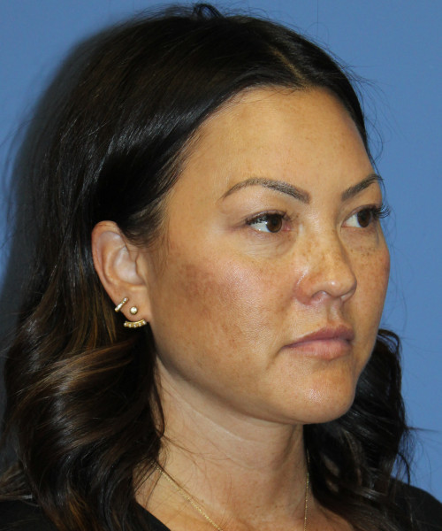 Blepharoplasty (eyelids) 5306 – Click HERE for more views before photo. Individual results may vary.
