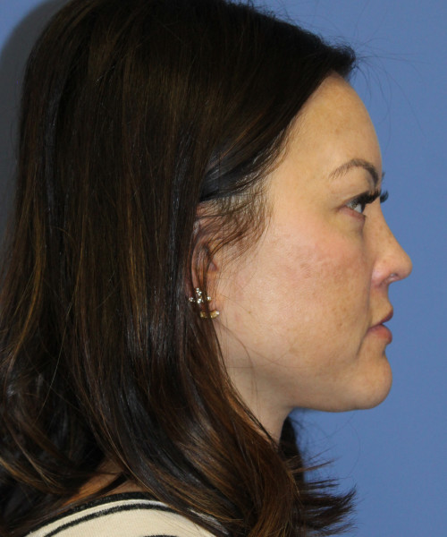 Blepharoplasty (eyelids) 5306 – Click HERE for more views after photo. Individual results may vary.