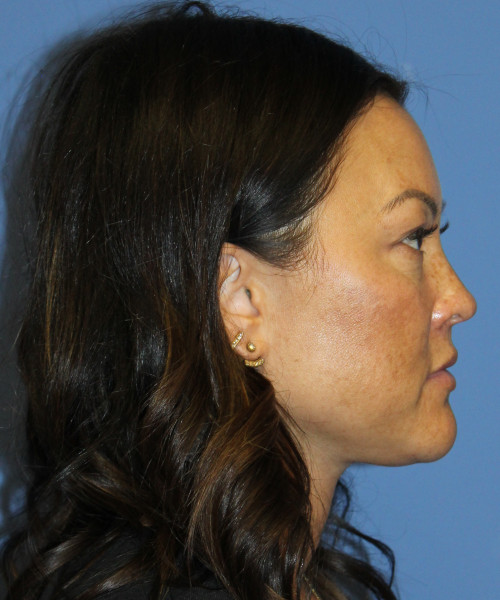 Blepharoplasty (eyelids) 5306 – Click HERE for more views before photo. Individual results may vary.