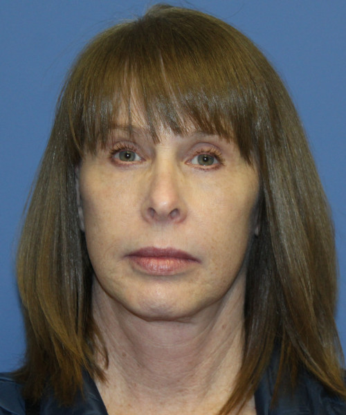 Facelift, Browlift, Lip Augmentation 5403 – Click HERE for more views after photo. Individual results may vary.