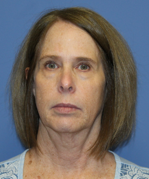 Facelift, Browlift, Lip Augmentation 5403 – Click HERE for more views before photo. Individual results may vary.