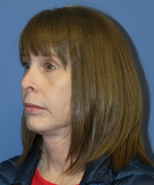 Facelift, Browlift, Lip Augmentation 5403 – Click HERE for more views after photo. Individual results may vary.