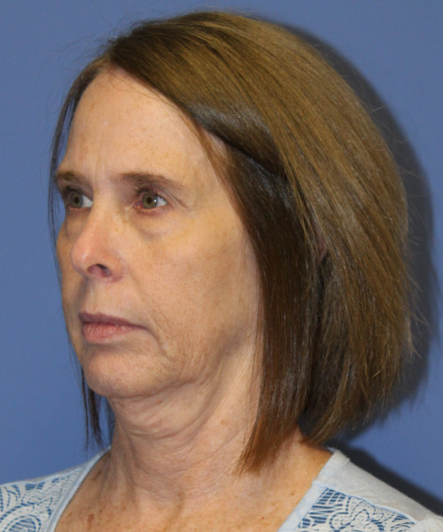 Facelift, Browlift, Lip Augmentation 5403 – Click HERE for more views before photo. Individual results may vary.