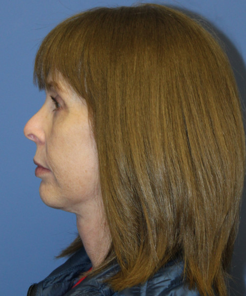 Facelift, Browlift, Lip Augmentation 5403 – Click HERE for more views after photo. Individual results may vary.