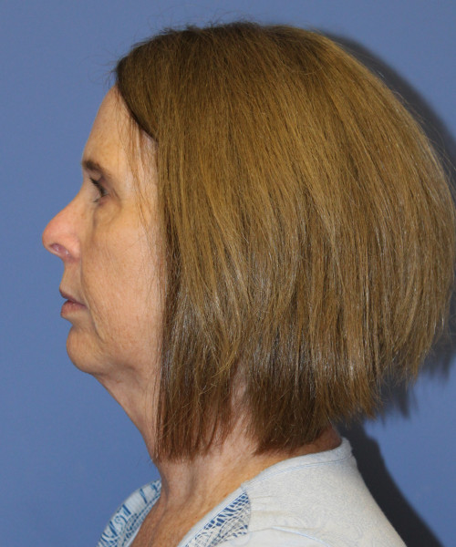 Facelift, Browlift, Lip Augmentation 5403 – Click HERE for more views before photo. Individual results may vary.