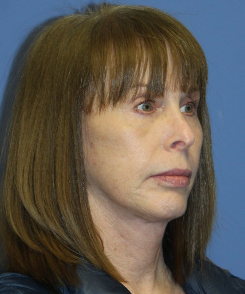 Facelift, Browlift, Lip Augmentation 5403 – Click HERE for more views after photo. Individual results may vary.