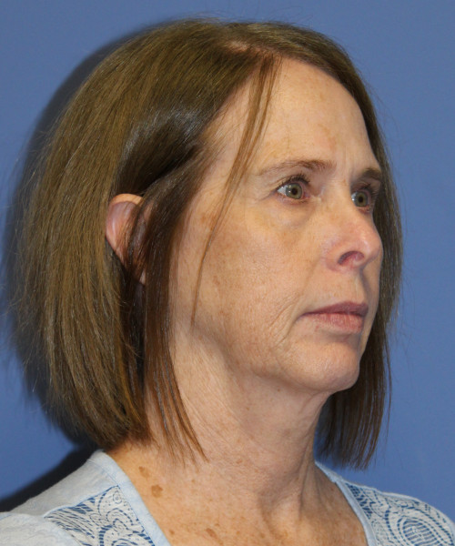 Facelift, Browlift, Lip Augmentation 5403 – Click HERE for more views before photo. Individual results may vary.