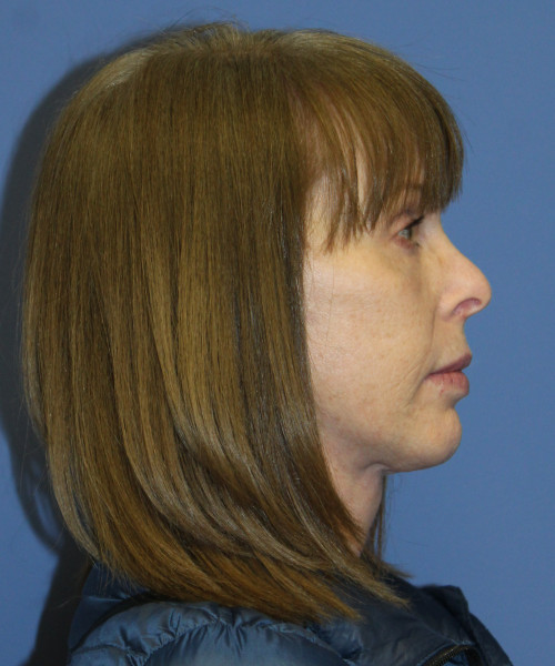 Facelift, Browlift, Lip Augmentation 5403 – Click HERE for more views after photo. Individual results may vary.