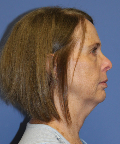 Facelift, Browlift, Lip Augmentation 5403 – Click HERE for more views before photo. Individual results may vary.