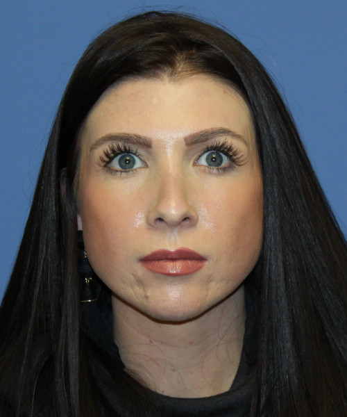 Dorsal Rhinoplasty 5414 – Click HERE for more views after photo. Individual results may vary.