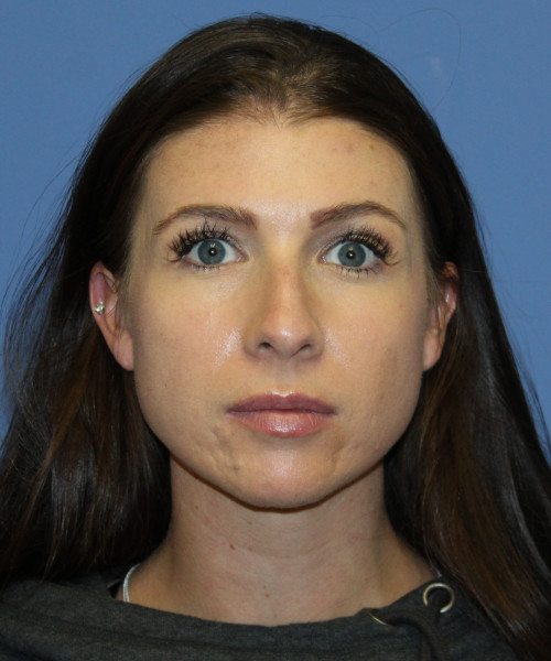 Dorsal Rhinoplasty 5414 – Click HERE for more views before photo. Individual results may vary.