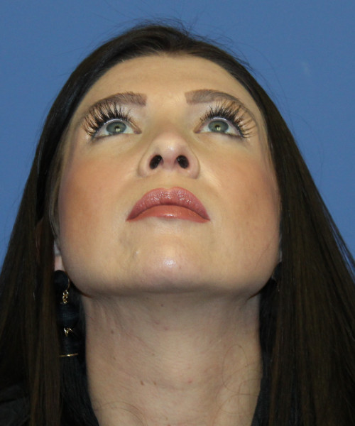 Dorsal Rhinoplasty 5414 – Click HERE for more views after photo. Individual results may vary.