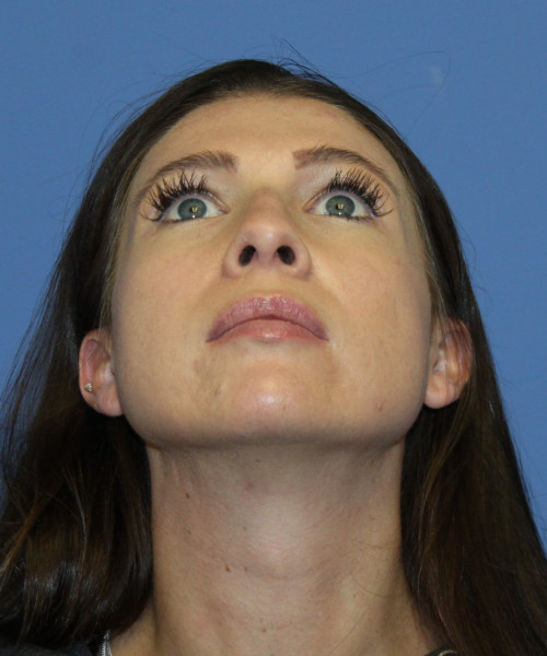 Dorsal Rhinoplasty 5414 – Click HERE for more views before photo. Individual results may vary.