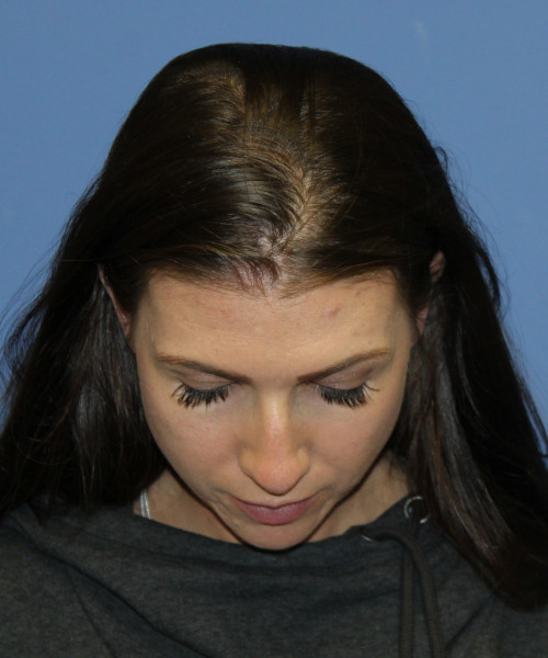 Dorsal Rhinoplasty 5414 – Click HERE for more views before photo. Individual results may vary.