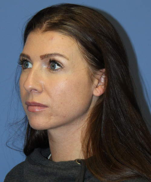 Dorsal Rhinoplasty 5414 – Click HERE for more views before photo. Individual results may vary.