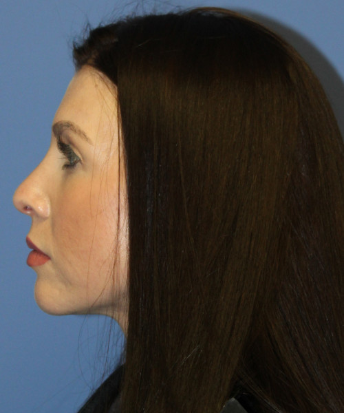 Dorsal Rhinoplasty 5414 – Click HERE for more views after photo. Individual results may vary.