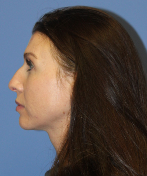 Dorsal Rhinoplasty 5414 – Click HERE for more views before photo. Individual results may vary.