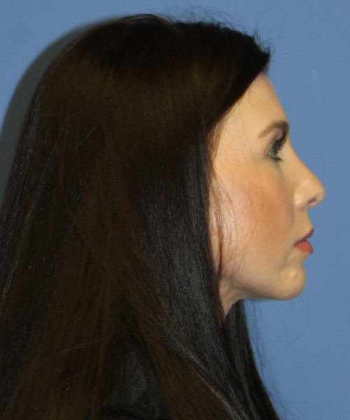 Dorsal Rhinoplasty 5414 – Click HERE for more views after photo. Individual results may vary.