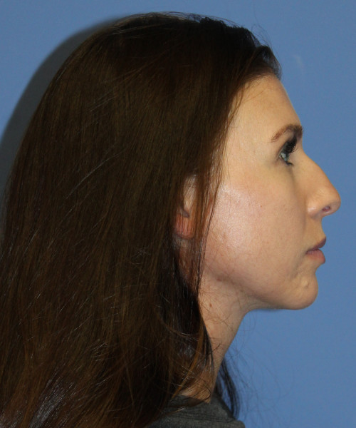 Dorsal Rhinoplasty 5414 – Click HERE for more views before photo. Individual results may vary.