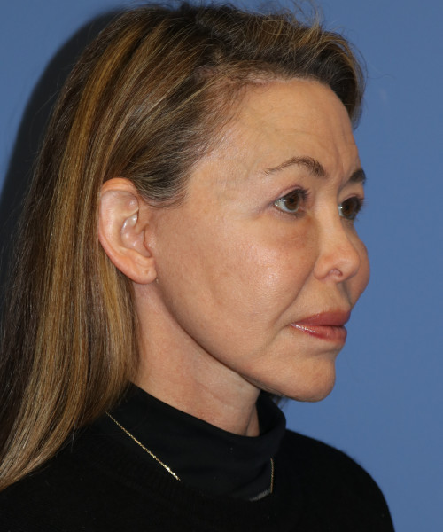 Facelift, Browlift, Blepharoplasty, Laser Skin Resurfacing 5429 – Click HERE for more views after photo. Individual results may vary.