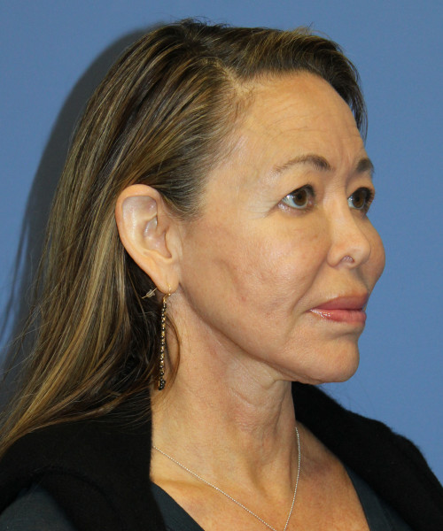 Facelift, Browlift, Blepharoplasty, Laser Skin Resurfacing 5429 – Click HERE for more views before photo. Individual results may vary.