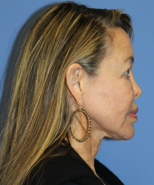 Facelift, Browlift, Blepharoplasty, Laser Skin Resurfacing 5429 – Click HERE for more views before photo. Individual results may vary.