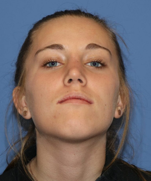 Rhinoplasty 5458 – Click HERE for more views after photo. Individual results may vary.