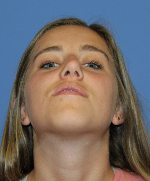 Rhinoplasty 5458 – Click HERE for more views before photo. Individual results may vary.