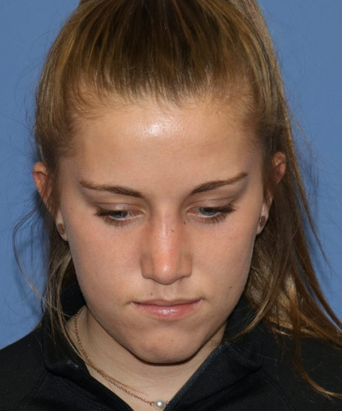 Rhinoplasty 5458 – Click HERE for more views after photo. Individual results may vary.