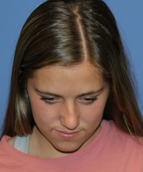 Rhinoplasty 5458 – Click HERE for more views before photo. Individual results may vary.
