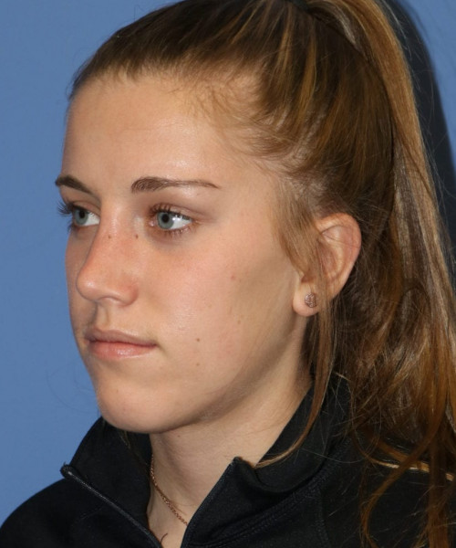 Rhinoplasty 5458 – Click HERE for more views after photo. Individual results may vary.
