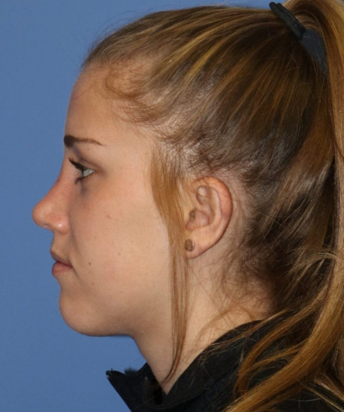 Rhinoplasty 5458 – Click HERE for more views after photo. Individual results may vary.