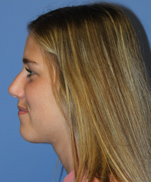 Rhinoplasty 5458 – Click HERE for more views before photo. Individual results may vary.
