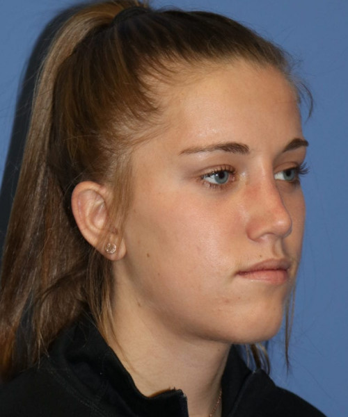 Rhinoplasty 5458 – Click HERE for more views after photo. Individual results may vary.