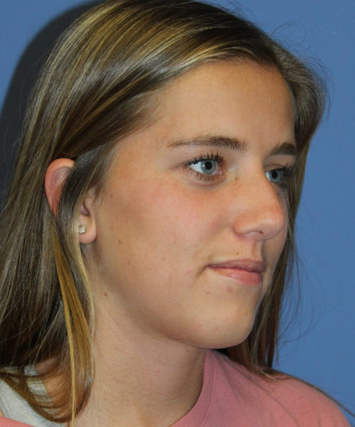 Rhinoplasty 5458 – Click HERE for more views before photo. Individual results may vary.