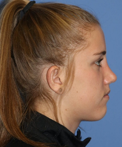 Rhinoplasty 5458 – Click HERE for more views after photo. Individual results may vary.