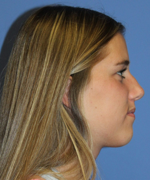 Rhinoplasty 5458 – Click HERE for more views before photo. Individual results may vary.